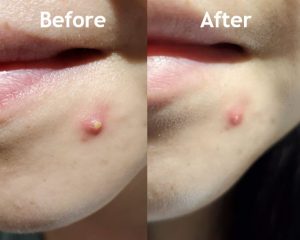 Huge improvement in my active pimples. Before/after image of my skin from using Nu Skin's Glacial Marine Mud.